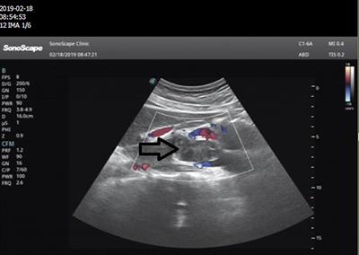 Treatment of a Double Cancer Patient With Primary Inferior Vena Cava Sarcoma and Lung Adenocarcinoma: A Case Report and Literature Review